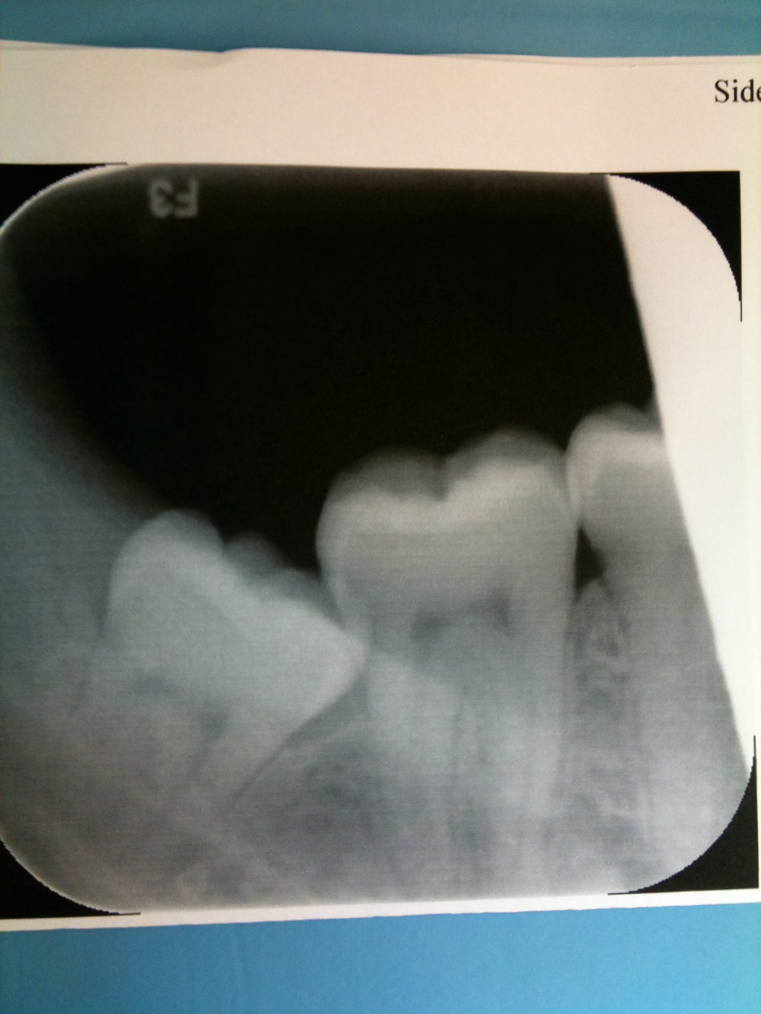 Nicks Wisdom Tooth Nicks Wisdom Tooth