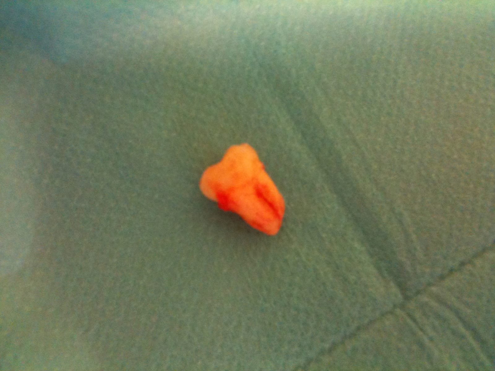 Nicks Wisdom Tooth The Little Bastard